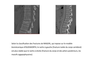 Selon	
  la	
  classiﬁcaFon	
  des	
  fractures	
  de	
  MAGERL,	
  qui	
  repose	
  sur	
  le	
  modèle	
  
biomécanique	
  d’OLDSWORTH,	
  le	
  rachis	
  à	
  gauche	
  (fracture	
  isolée	
  du	
  corps	
  vertébral)	
  
est	
  plus	
  stable	
  que	
  le	
  rachis	
  à	
  droite	
  (fracture	
  du	
  corps	
  et	
  des	
  piliers	
  postérieurs,	
  les	
  
massifs	
  zygapophysaires)	
  
 