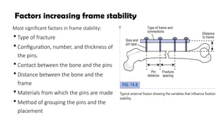 Comprehensive Biomechanics of Fractures and Fixation Techniques in ...