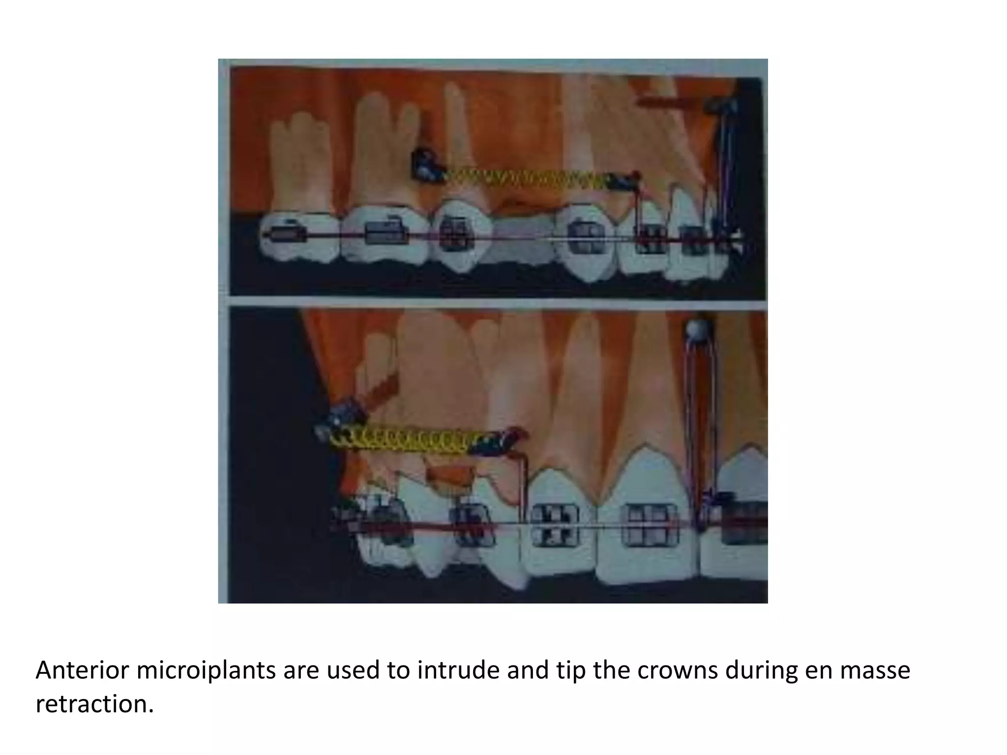 Biomechanical considerations in microimplants | PPT