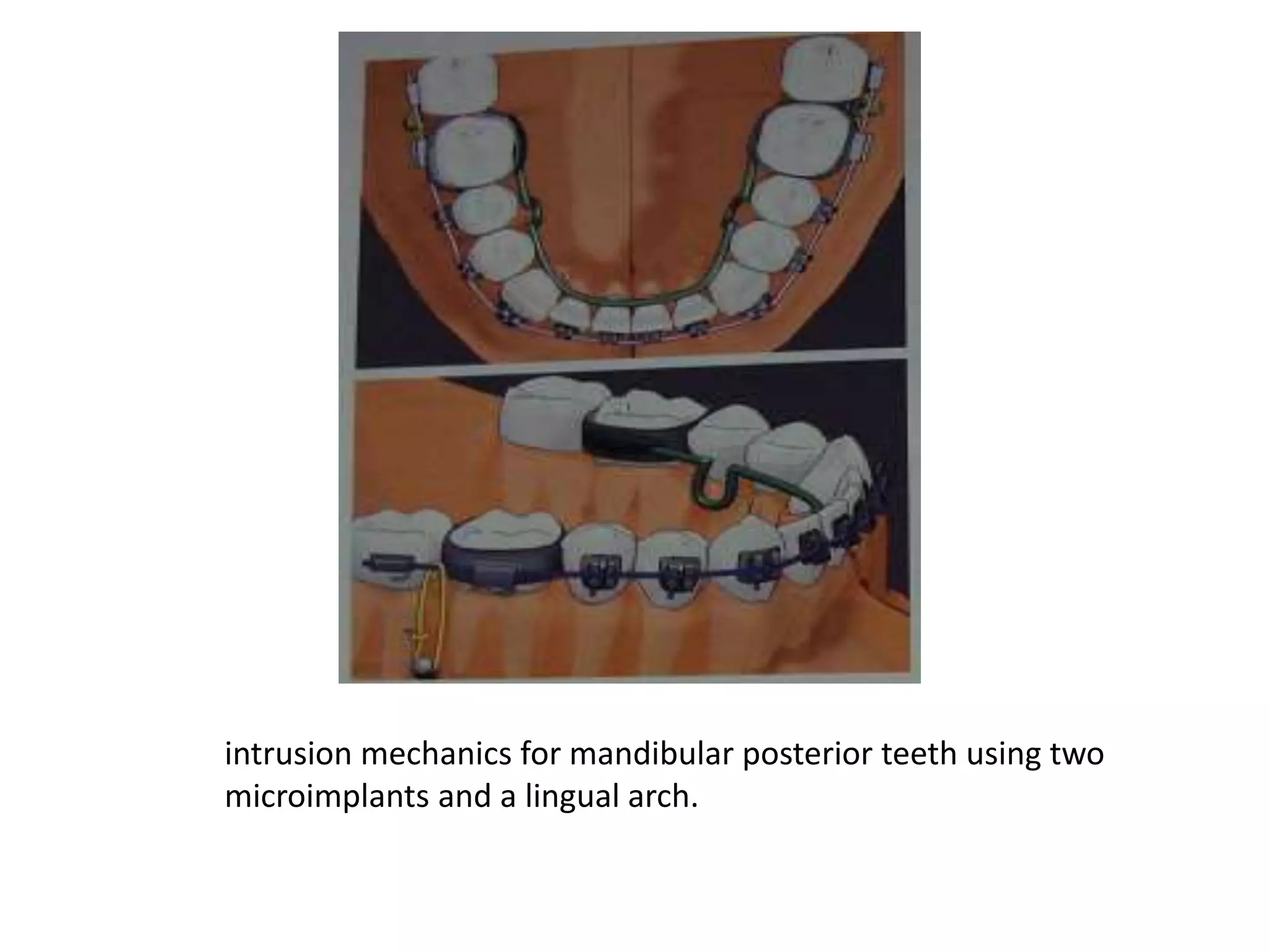 Biomechanical considerations in microimplants | PPT