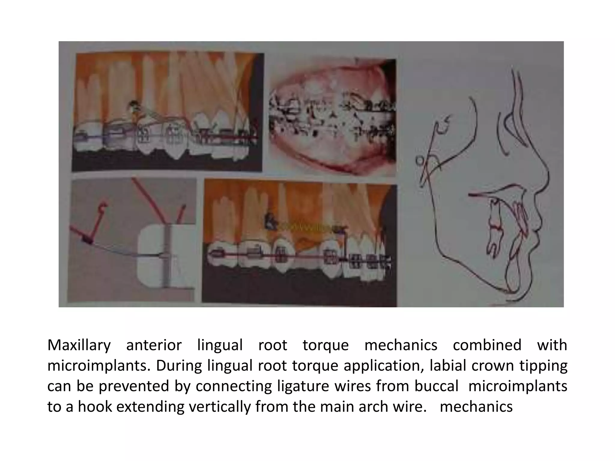 Biomechanical considerations in microimplants | PPT