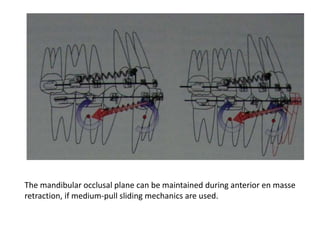The mandibular occlusal plane can be maintained during anterior en masse
retraction, if medium-pull sliding mechanics are used.
 