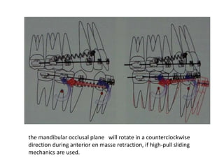 the mandibular occlusal plane will rotate in a counterclockwise
direction during anterior en masse retraction, if high-pull sliding
mechanics are used.
 