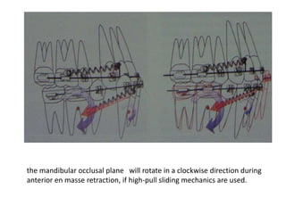 the mandibular occlusal plane will rotate in a clockwise direction during
anterior en masse retraction, if high-pull sliding mechanics are used.
 