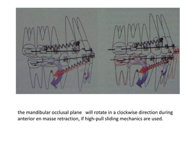 Biomechanical considerations in microimplants | PPT