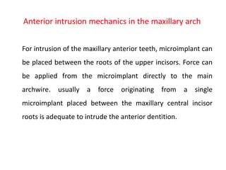 Anterior intrusion mechanics in the maxillary arch
For intrusion of the maxillary anterior teeth, microimplant can
be placed between the roots of the upper incisors. Force can
be applied from the microimplant directly to the main
archwire. usually a force originating from a single
microimplant placed between the maxillary central incisor
roots is adequate to intrude the anterior dentition.
 