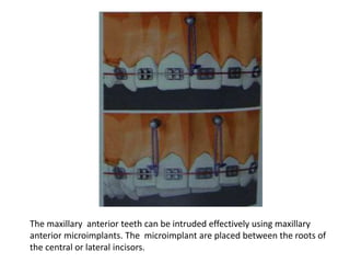 The maxillary anterior teeth can be intruded effectively using maxillary
anterior microimplants. The microimplant are placed between the roots of
the central or lateral incisors.
 