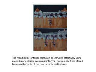 The mandibular anterior teeth can be intruded effectively using
mandibular anterior microimplants. The microimplant are placed
between the roots of the central or lateral incisors.
 