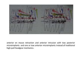 anterior en masse retraction and anterior intrusion with tow posterior
microimplants and one or tow anterior microimplants instead of traditional
high-pull headgear mechanics.
 