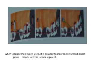 when loop mechanics are used, it is possible to incorporate second-order
gable bends into the incisor segment.
 