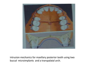intrusion mechanics for maxillary posterior teeth using two
buccal microimplants and a transpalatal arch.
 