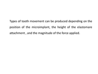 Types of tooth movement can be produced depending on the
position of the microimplant, the height of the elastomare
attachment , and the magnitude of the force applied.
 
