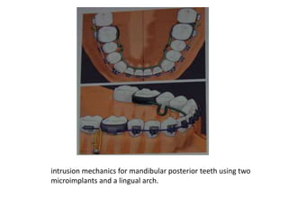 intrusion mechanics for mandibular posterior teeth using two
microimplants and a lingual arch.
 