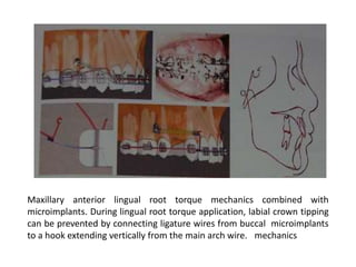 Maxillary anterior lingual root torque mechanics combined with
microimplants. During lingual root torque application, labial crown tipping
can be prevented by connecting ligature wires from buccal microimplants
to a hook extending vertically from the main arch wire. mechanics
 