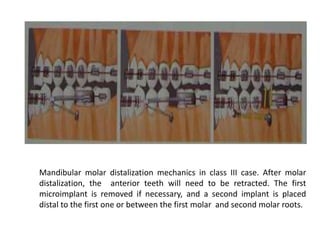 Mandibular molar distalization mechanics in class III case. After molar
distalization, the anterior teeth will need to be retracted. The first
microimplant is removed if necessary, and a second implant is placed
distal to the first one or between the first molar and second molar roots.
 