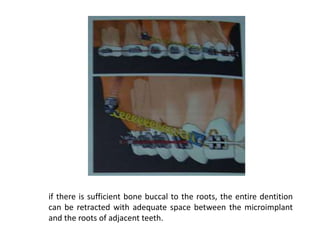 if there is sufficient bone buccal to the roots, the entire dentition
can be retracted with adequate space between the microimplant
and the roots of adjacent teeth.
 