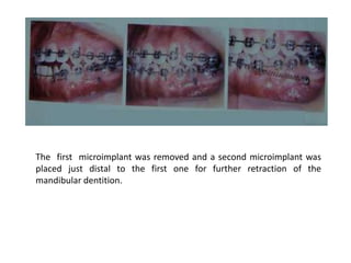The first microimplant was removed and a second microimplant was
placed just distal to the first one for further retraction of the
mandibular dentition.
 