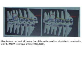 Microimplant mechanics for retraction of the entire maxillary dentition in combination
with the MEAW technique of Kim(1999b,2000).
 