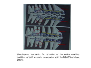 Microimplant mechanics for retraction of the entire maxillary
dentition of both arches in combination with the MEAW technique
of Kim.
 