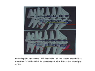 Microimplant mechanics for retraction of the entire mandibular
dentition of both arches in combination with the MEAW technique
of Kim.
 