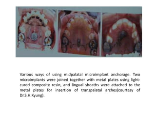 Various ways of using midpalatal microimplant anchorage. Two
microimplants were joined together with metal plates using light-
cured composite resin, and lingual sheaths were attached to the
metal plates for insertion of transpalatal arches(courtesy of
Dr.S.H.Kyung).
 