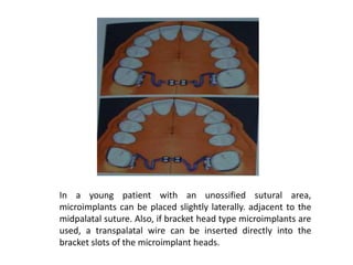In a young patient with an unossified sutural area,
microimplants can be placed slightly laterally. adjacent to the
midpalatal suture. Also, if bracket head type microimplants are
used, a transpalatal wire can be inserted directly into the
bracket slots of the microimplant heads.
 