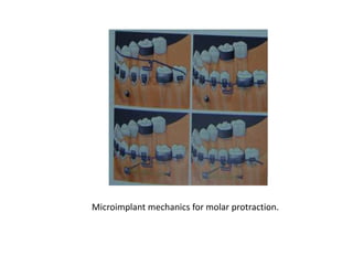 Microimplant mechanics for molar protraction.
 