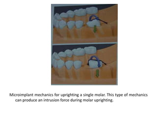 Microimplant mechanics for uprighting a single molar. This type of mechanics
can produce an intrusion force during molar uprighting.
 