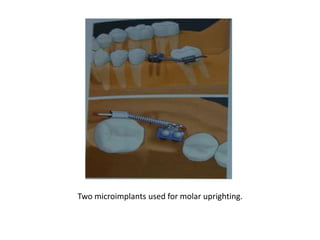 Two microimplants used for molar uprighting.
 