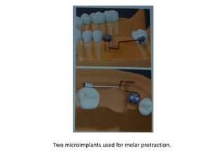 Two microimplants used for molar protraction.
 