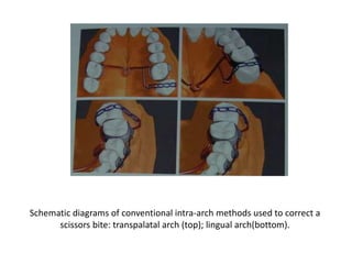 Schematic diagrams of conventional intra-arch methods used to correct a
scissors bite: transpalatal arch (top); lingual arch(bottom).
 