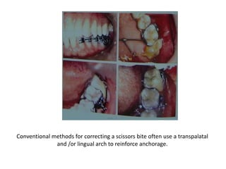Conventional methods for correcting a scissors bite often use a transpalatal
and /or lingual arch to reinforce anchorage.
 