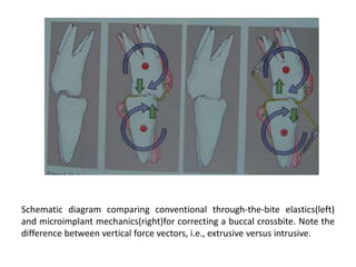 Schematic diagram comparing conventional through-the-bite elastics(left)
and microimplant mechanics(right)for correcting a buccal crossbite. Note the
difference between vertical force vectors, i.e., extrusive versus intrusive.
 