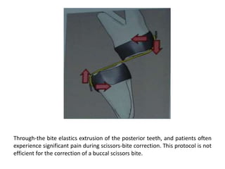 Through-the bite elastics extrusion of the posterior teeth, and patients often
experience significant pain during scissors-bite correction. This protocol is not
efficient for the correction of a buccal scissors bite.
 