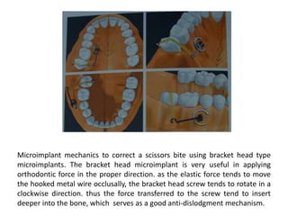 Microimplant mechanics to correct a scissors bite using bracket head type
microimplants. The bracket head microimplant is very useful in applying
orthodontic force in the proper direction. as the elastic force tends to move
the hooked metal wire occlusally, the bracket head screw tends to rotate in a
clockwise direction. thus the force transferred to the screw tend to insert
deeper into the bone, which serves as a good anti-dislodgment mechanism.
 