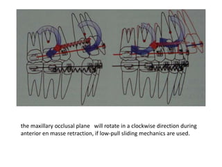 the maxillary occlusal plane will rotate in a clockwise direction during
anterior en masse retraction, if low-pull sliding mechanics are used.
 