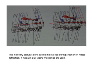 The maxillary occlusal plane can be maintained during anterior en masse
retraction, if medium-pull sliding mechanics are used.
 