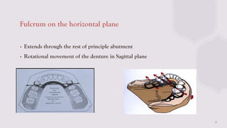 BIOMECHANICAL PRINCIPALS IN RPD IN PROSTHODONTICCS | PPTX