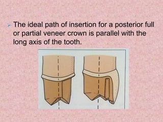 Biomechanical principles of TOOTH PREPARATION | PPTX