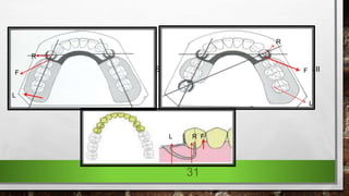 Biomechanical problems associated with free end saddle dentures | PPTX