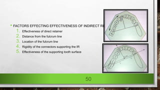 • FACTORS EFFECTING EFFECTIVENESS OF INDIRECT RETAINER:
1. Effectiveness of direct retainer
2. Distance from the fulcrum line
3. Location of the fulcrum line
4. Rigidity of the connectors supporting the IR
5. Effectiveness of the supporting tooth surface
50
 