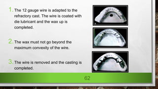 1.The 12 gauge wire is adapted to the
refractory cast. The wire is coated with
die lubricant and the wax up is
completed.
2.The wax must not go beyond the
maximum convexity of the wire.
3.The wire is removed and the casting is
completed.
62
 
