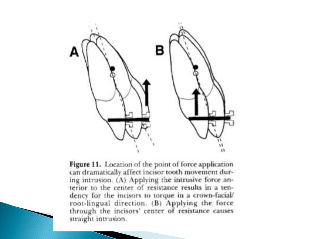 Orthodontic Biomechanics