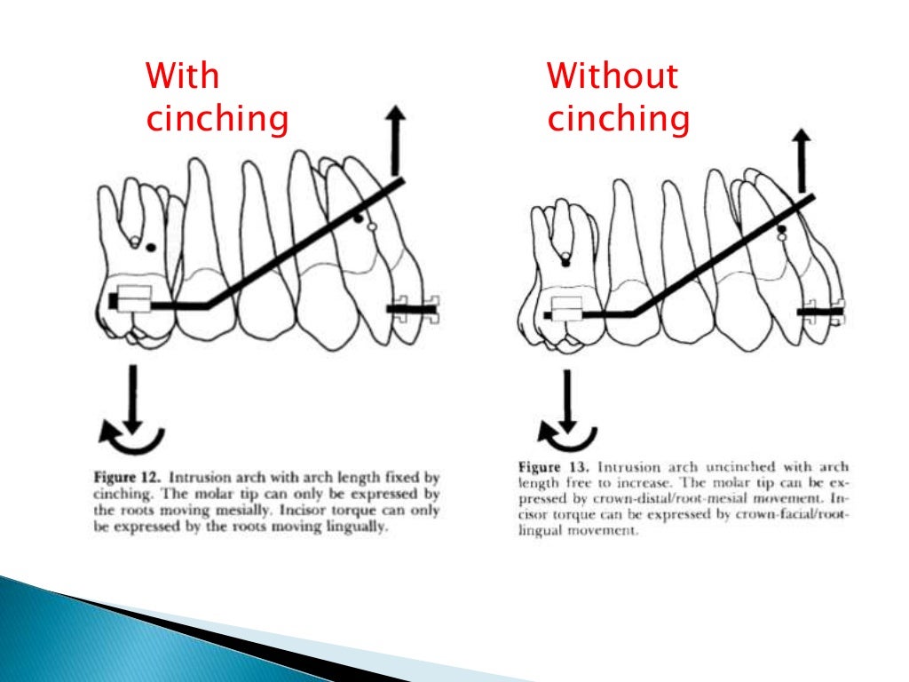 Orthodontic Biomechanics