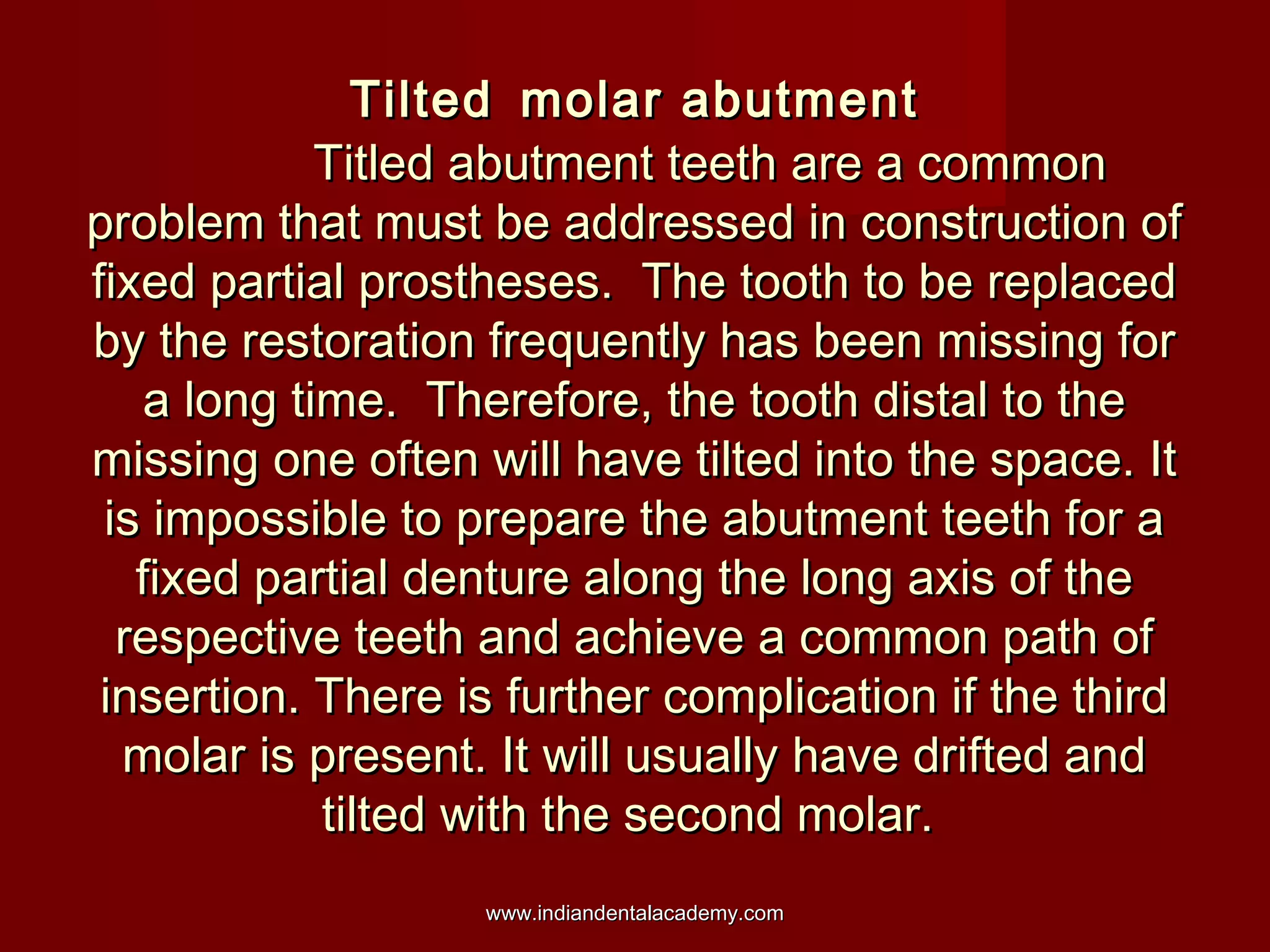 Tilted molar abutment
Titled abutment teeth are a common
problem that must be addressed in construction of
fixed partial prostheses. The tooth to be replaced
by the restoration frequently has been missing for
a long time. Therefore, the tooth distal to the
missing one often will have tilted into the space. It
is impossible to prepare the abutment teeth for a
fixed partial denture along the long axis of the
respective teeth and achieve a common path of
insertion. There is further complication if the third
molar is present. It will usually have drifted and
tilted with the second molar.
www.indiandentalacademy.com

 