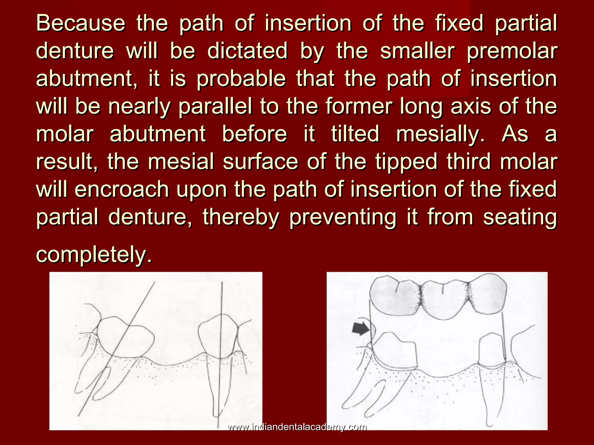 Because the path of insertion of the fixed partial
denture will be dictated by the smaller premolar
abutment, it is probable that the path of insertion
will be nearly parallel to the former long axis of the
molar abutment before it tilted mesially. As a
result, the mesial surface of the tipped third molar
will encroach upon the path of insertion of the fixed
partial denture, thereby preventing it from seating
completely.

www.indiandentalacademy.com

 