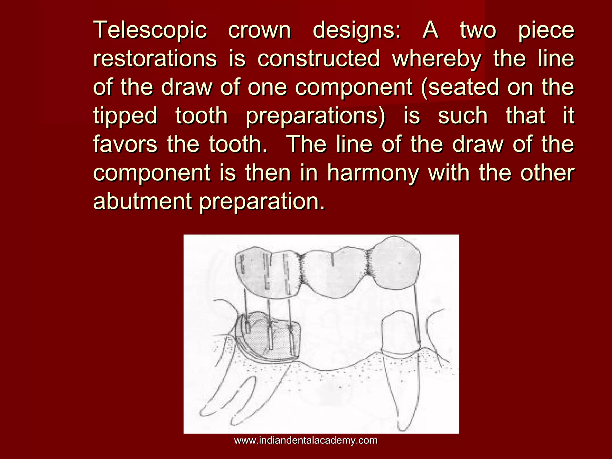 Telescopic crown designs: A two piece
restorations is constructed whereby the line
of the draw of one component (seated on the
tipped tooth preparations) is such that it
favors the tooth. The line of the draw of the
component is then in harmony with the other
abutment preparation.

www.indiandentalacademy.com

 