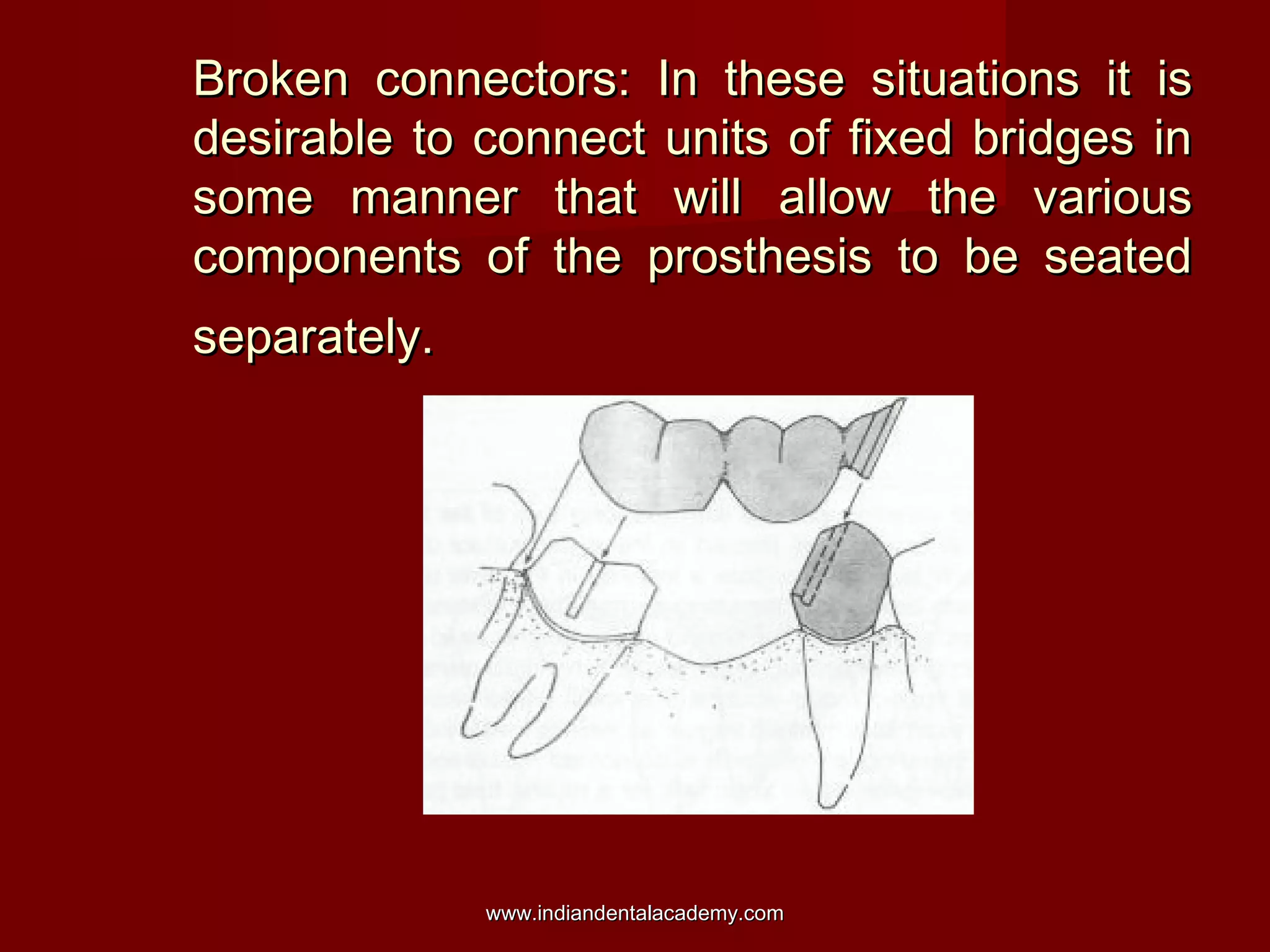 Broken connectors: In these situations it is
desirable to connect units of fixed bridges in
some manner that will allow the various
components of the prosthesis to be seated
separately.

www.indiandentalacademy.com

 