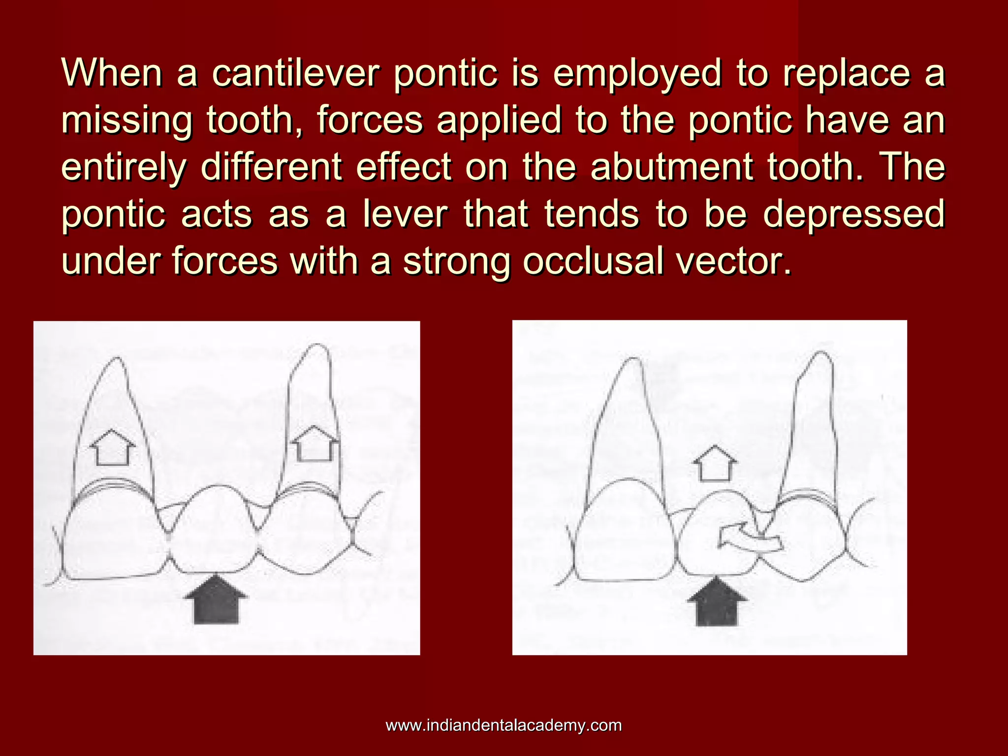 When a cantilever pontic is employed to replace a
missing tooth, forces applied to the pontic have an
entirely different effect on the abutment tooth. The
pontic acts as a lever that tends to be depressed
under forces with a strong occlusal vector.

www.indiandentalacademy.com

 