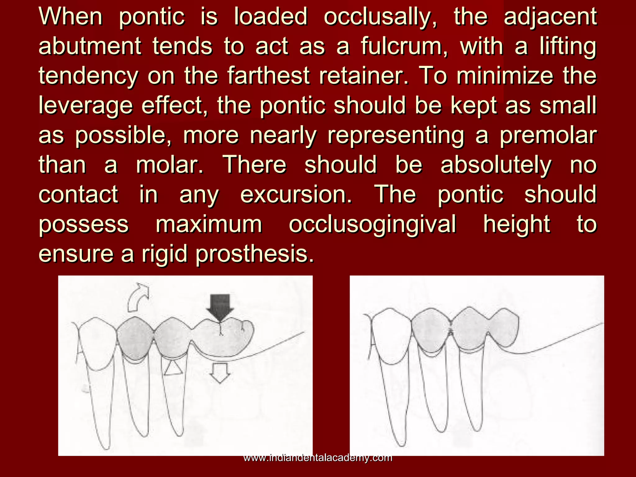When pontic is loaded occlusally, the adjacent
abutment tends to act as a fulcrum, with a lifting
tendency on the farthest retainer. To minimize the
leverage effect, the pontic should be kept as small
as possible, more nearly representing a premolar
than a molar. There should be absolutely no
contact in any excursion. The pontic should
possess maximum occlusogingival height to
ensure a rigid prosthesis.

www.indiandentalacademy.com

 